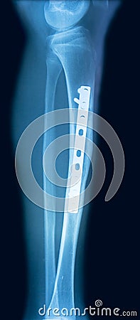 Film x-ray tibia Stock Photo